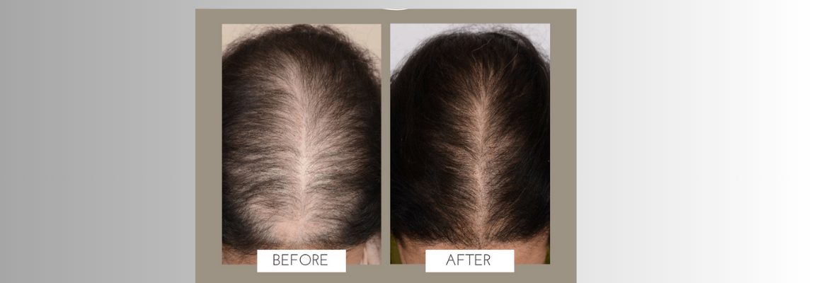 Unlocking the Secret to Lush Locks: Exploring Advanced PRP Treatment for Hair Restoration
